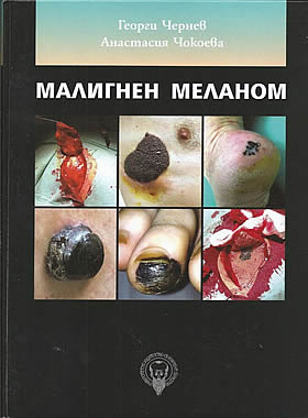 Малигнен меланом